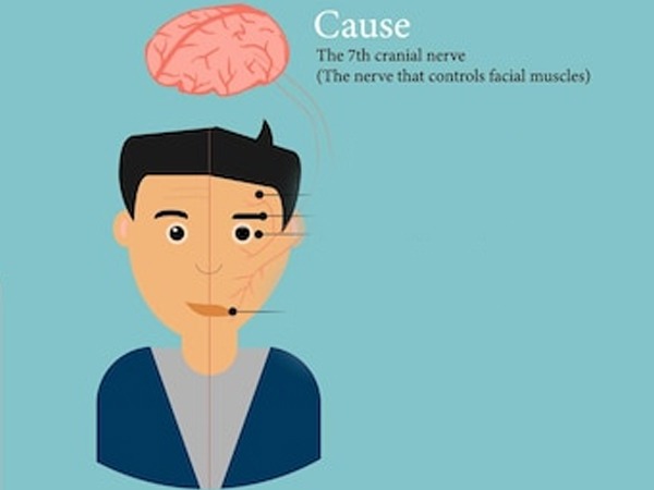 Causes-of-cerebral-palsy