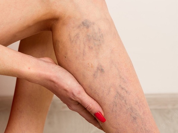 Discover-How-To-Naturally-Get-Rid-Of-Varicose-Veins-In-Just-A-Few-Weeks