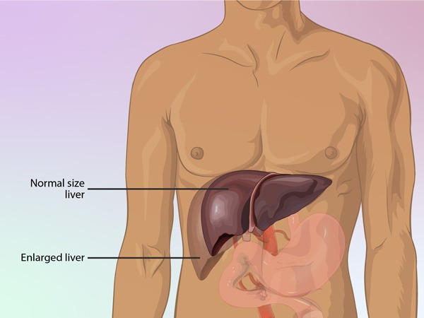 Enlarged-Liver-Find-Out-Now-And-Get-The-Treatment