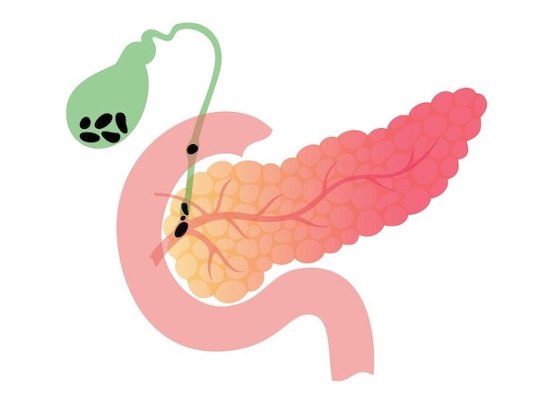 Is gallbladder removal necessary?