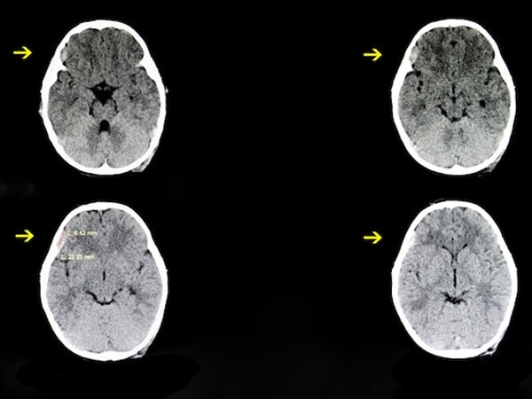 Subdural-Hematoma