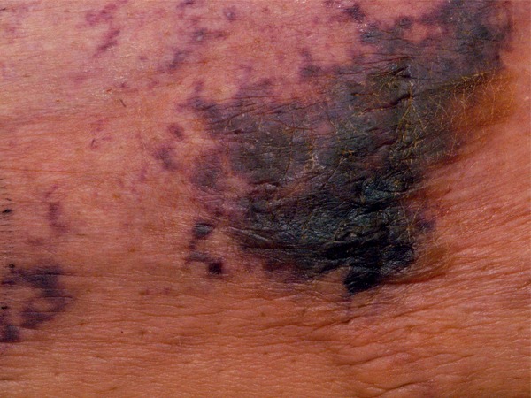 What-is-Calciphylaxis