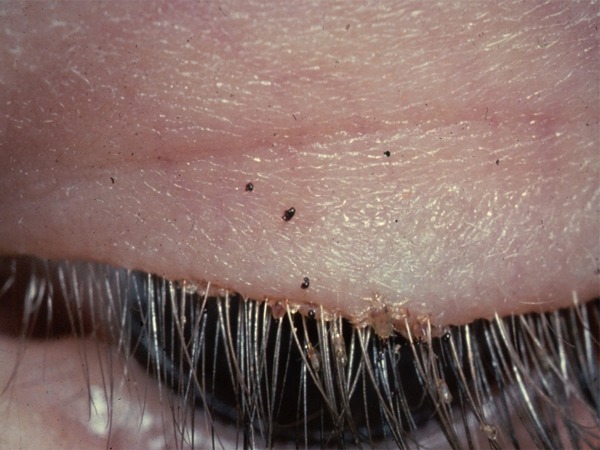 Pubic Lice Treatment How To Get Rid Of It Effectively TV Health