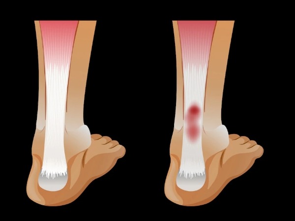 Facts on Ewing's Sarcoma