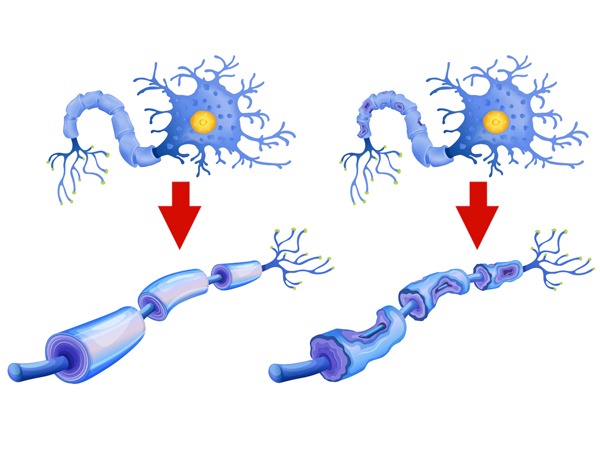 Get-to-Know-Motor-Neuron-Disease