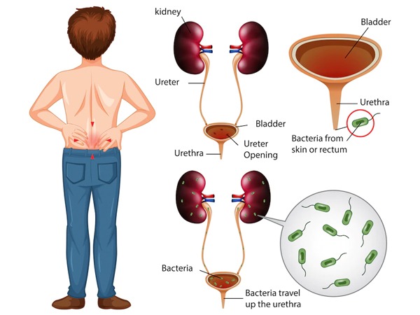 Here's how men can prevent UTIs in men.