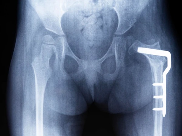 Hip Dysplasia Treatment Options