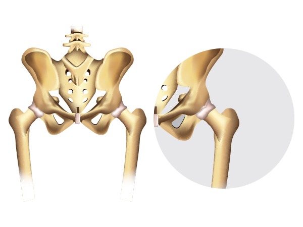Know About Hip Dysplasia