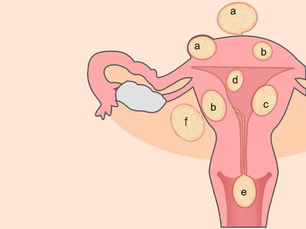 Risk Factors of Uterine Fibroid
