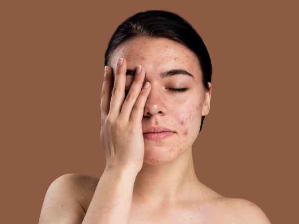 How You Can Remove Blackheads With Hydrogen peroxide