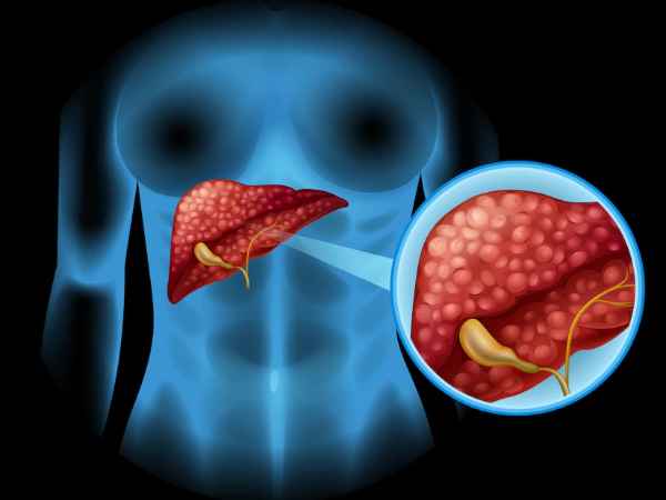 Pancreatic Cancer All About The Silent Killer!