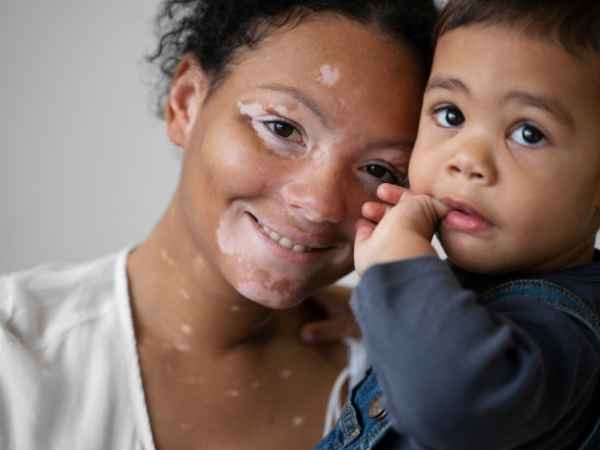 What Is Vitiligo, And Why Should I Care? – Minnesota Spokesman-Recorder ...