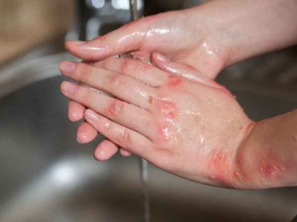 Treatment Options for Eczema Scar