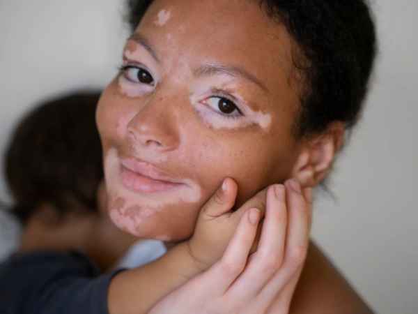 Vitiligo On Lips Learn Treatment & Prevention Now!