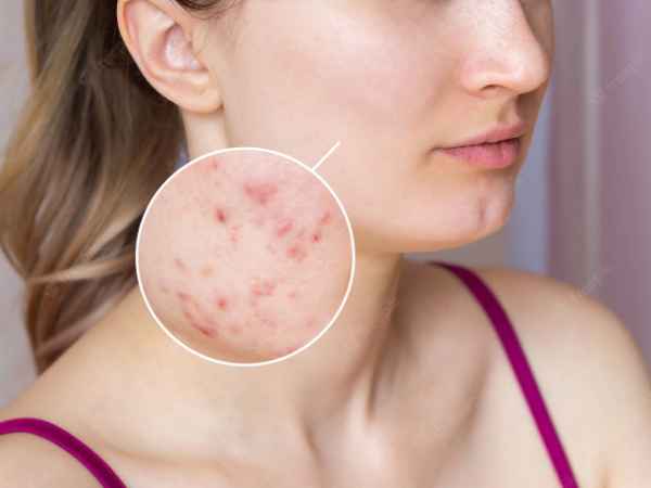 What causes blackheads