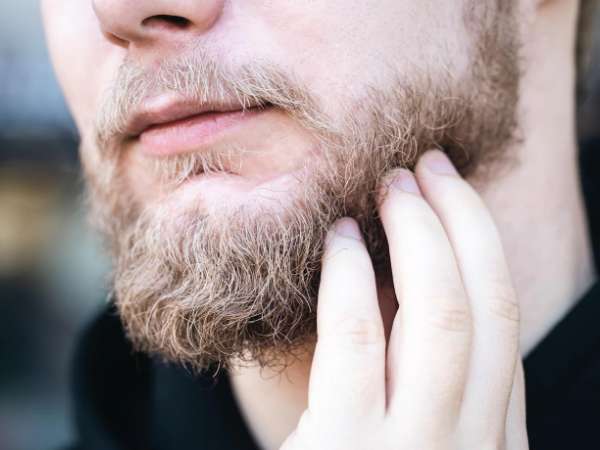 Beard Dandruff Best Home Remedies & Treatments