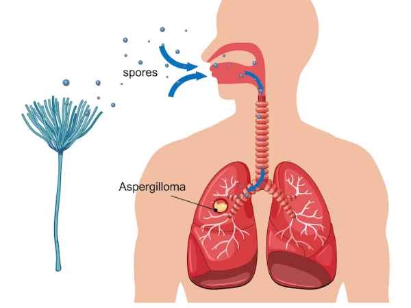 An Introduction To Chronic Obstructive Pulmonary Disease