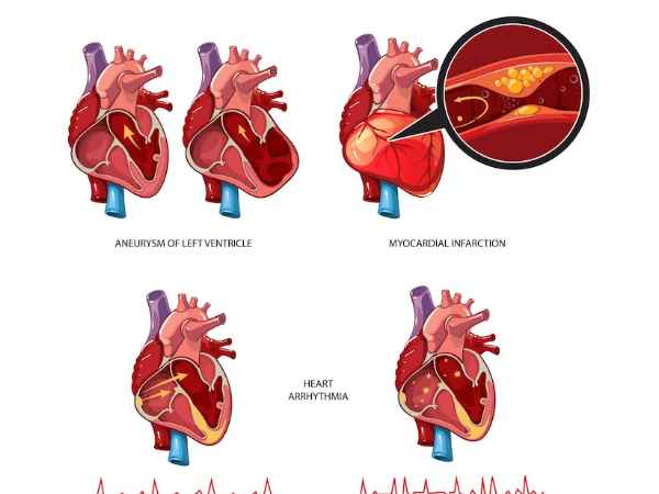 Find Out What is Percutaneous Coronary Intervention Today!