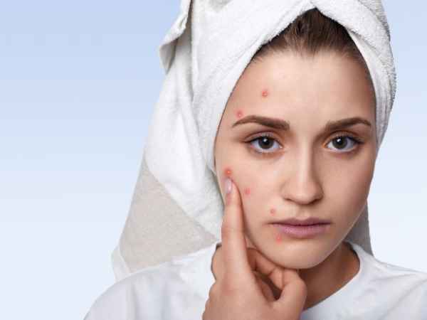 Pimple Free Skin The Ultimate Guide For Clear Skin!