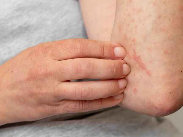 Types Of Skin Diseases