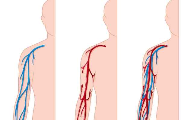 Peripheral Artery Disease Causes And Treatment!