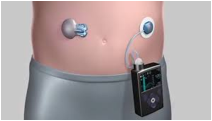 Closed-Loop insulin pump