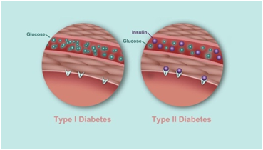 t1d and t2d