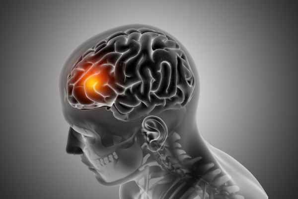 Introduction to Infarct in Brain