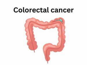 Colorectal cancer_ Understanding the Silent Menace