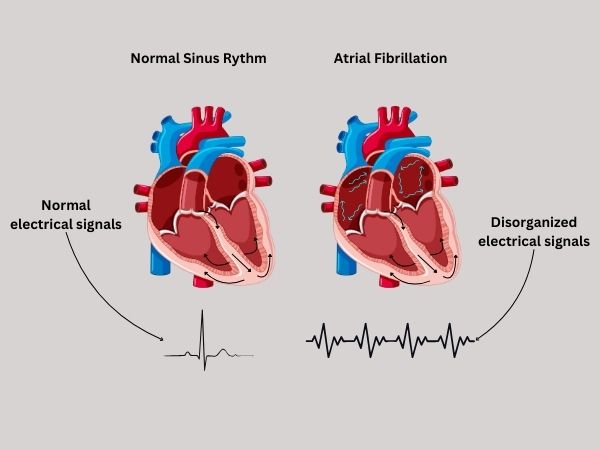 Heart Arrhythmia_ Causes, Symptoms, and Treatment Options