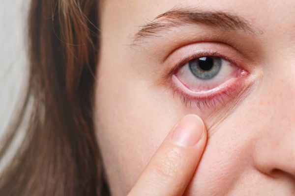 Swollen Eyelids Managing and Preventing Eye Allergic Reactions