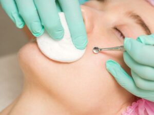 Blackhead Removal_ Unmasking the Secrets of Flawless Skin!