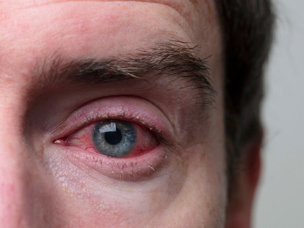 Conjunctivitis- An Introduction