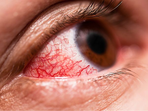 Conjunctivitis: Symptoms, Treatment, and Home Remedies