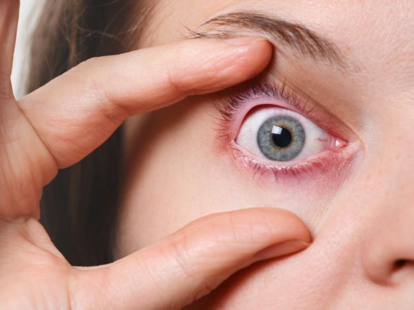 How Long Does Conjunctivitis Last