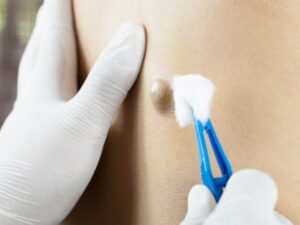 Sebaceous Cysts_ Causes, Symptoms, Treatment, and Removal