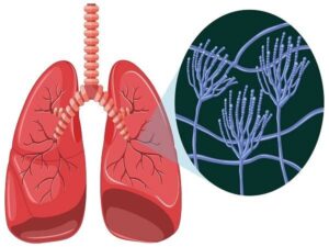 Understanding Cystic Fibrosis Symptoms, Treatment, Inheritance