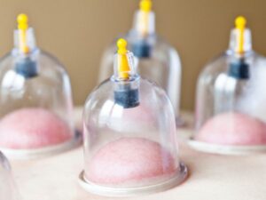 Cupping Therapy_ Know Procedure, Benefits, Side- Effects