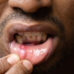 Relief in Your Kitchen_ Home Remedies for Painful Tongue Ulcers
