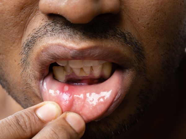 Home Remedies for Painful Tongue Ulcers