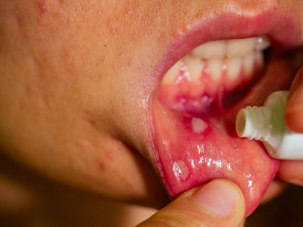 Tongue Ulcer Treatment At Home