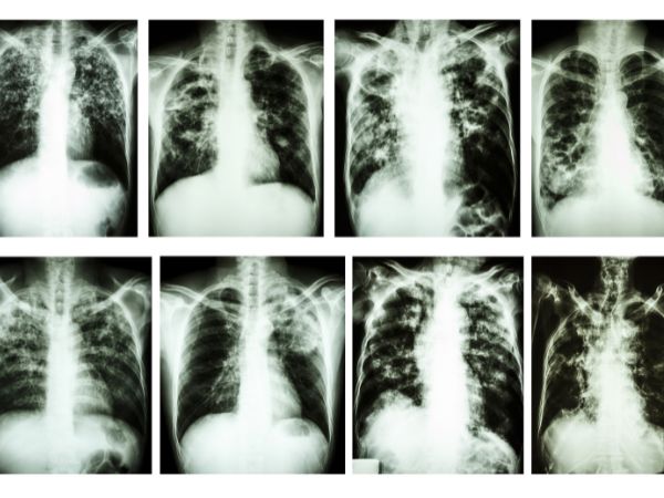 Understanding Spinal Tuberculosis 