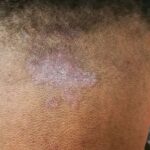 Tinea capitis_ All You Need To Know About Scalp Fungus