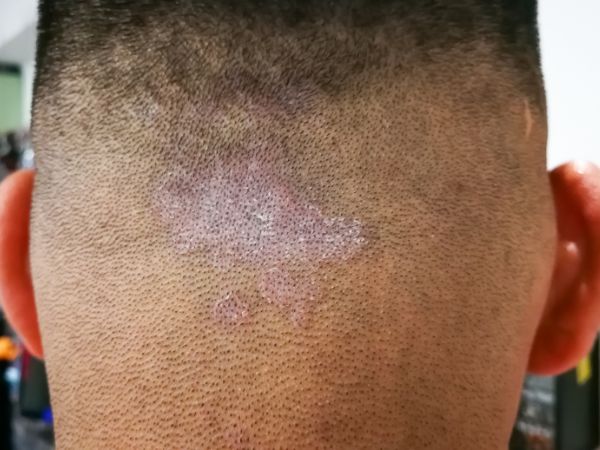 Tinea capitis: All You Need To Know About Scalp Fungus