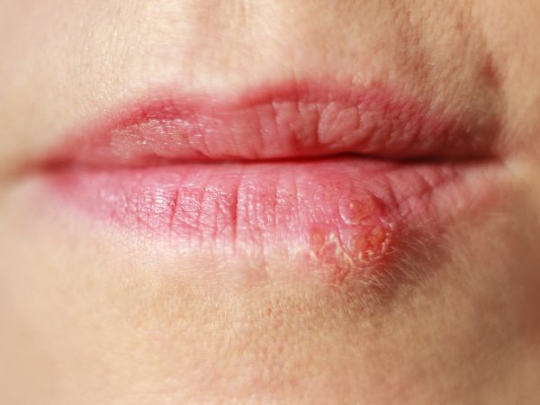 Cold Sores, Caused by Herpes Simplex Virus, Demand Proactive