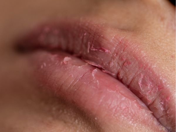 Why Lips Dry in Winter and How to Care for Them