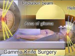 Gamma Knife Surgery Radiation