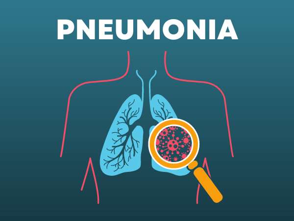Pneumonia: Causes, Symptoms, Diagnosis & Treatment