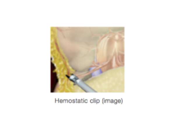 Hemostasis Clip
