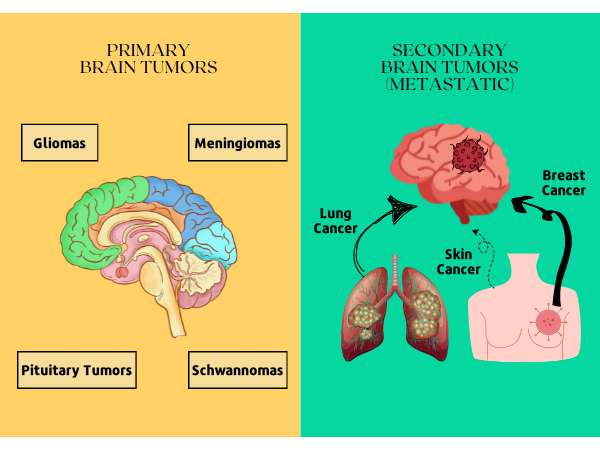 Types of Brain Cancer